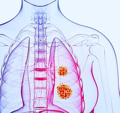 Lung Cancer