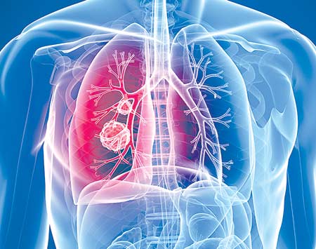 Lung Cancer