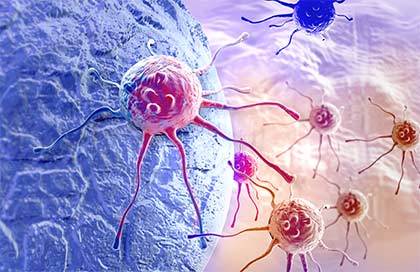 Cancer Tumor