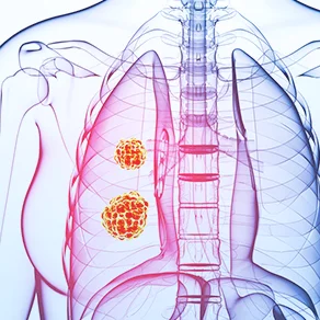 Tumor Profiling