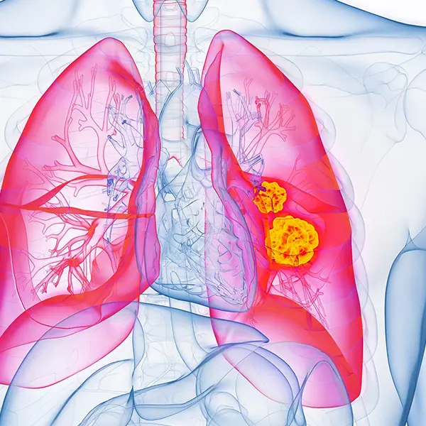 Genetic profiling of lung adenocarcinomas